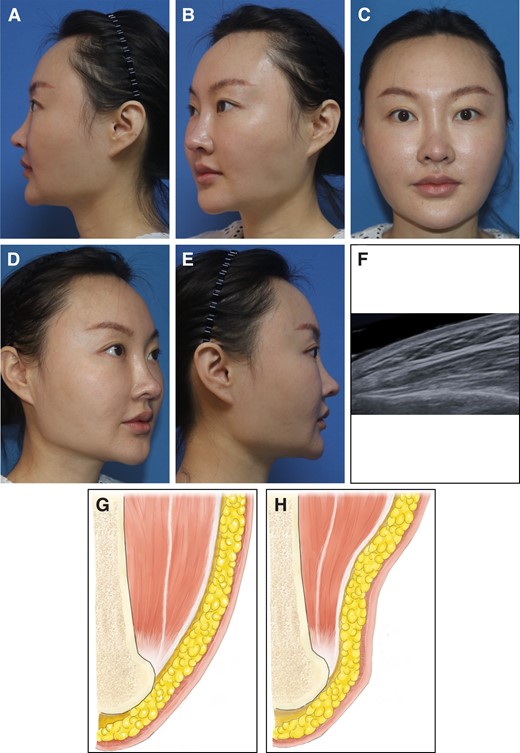 A case of contour visibility of the mandibular angle, and schematic diagrams of the possible cause. (A-E) A representative case of contour visibility of the mandibular angle: (A) left lateral view, (B), left oblique view, (C) frontal view, (D) right oblique view, (E) right lateral view. (F) Ultrasound image of the patient's mandibular angle, which is extrovert in this case. (G) Schematic diagram before injection. The extrovert mandibular angle is covered by masseter, creating a smooth lower facial contour. (H) Schematic diagram after BoNT-A injection. The thickness of masseter is significantly reduced, and the extrovert mandibular angle is now visible. BoNT-A, botulinum neurotoxin A.