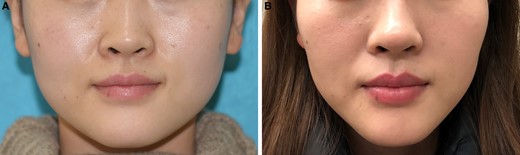 A case of sunken cheek. (A) Before injection and (B) 1 month after injection.