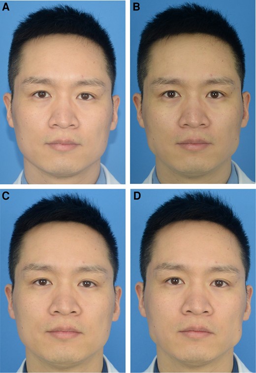 A case of paradoxical muscle bulging. (A) Before injection and (B) 1 week after injection, static. (C) Before injection and (D) 1 week after injection, clenching.