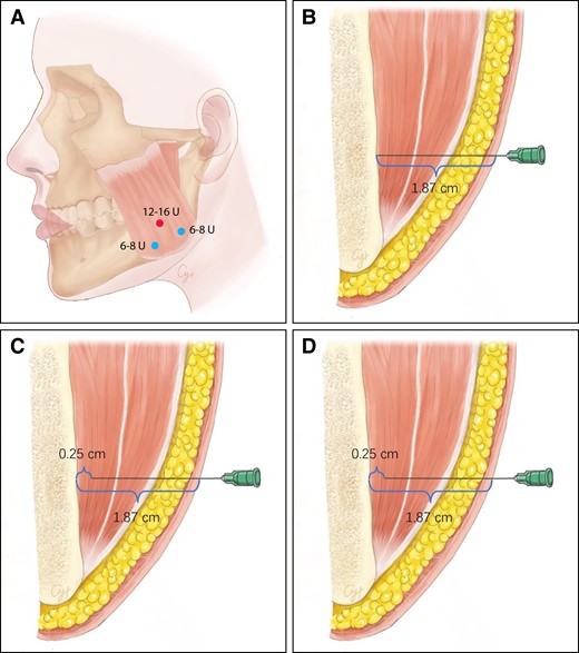 Schematic diagram of the recommended botulinum toxin injection strategy. (A) An example of botulinum toxin injection dose and sites. The red dot represents the most prominent point of masseter, determined by palpation during clenching; 12 to 16 units of botulinum toxin should be injected into this point in total. The blue dots represent the lower injection points, which should form an isosceles triangle with the red dot; 6 to 8 units of botulinum toxin should be injected into these points, respectively. (B) Enter the skin vertically until the needle tip reaches the periosteum. (C) Retract for approximately 0.25 cm; the needle tip should be in the center of the deep belly of the superficial part of masseter. Half of the dose should be injected into this layer. (D) Further retract for approximately 0.65 cm; the needle tip should reach the center of the superficial muscle belly, the other half of the due dose of a point should be injected into this layer.