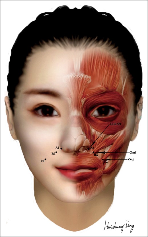 Marked points and injection sites of the nasolabial fold. LLSAN, levator labii alaeque nasi; Zmi, zygomaticus minor; Zmj, zygomaticus major. Created by and published with permission from Huishuang Dong.