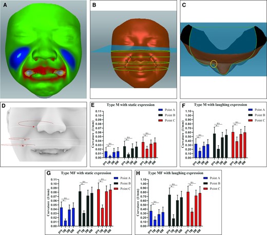 Pretreatment and posttreatment 3D facial images of static expression were fitted. (A) The colors in the different facial areas represent depth variation. The Frankfurt plane is the reference horizontal plane in Artec Studio (Artec 3D; Senningerberg, Luxembourg), and was adjusted to generate 3 horizontal planes where A, B, and C were located. The cross-sectional lines in the 3 planes are captured. (B) The 3D facial images before and after injection were superimposed, and the cross-sectional lines of each layer were extracted. (C) Two green lines indicate the contours of pretreatment and posttreatment models. The circle indicates the right area of the patient's NLF in vertical view. (D) The red circles represent the pretreatment curvature of a type M NLF while laughing in Rhino software. (E-H) The curvature change with time was analyzed by Rhino in both type M and type MF NLFs. The radius of the curvature is measured in millimeters. M, muscular type; MF, muscle–fat pad mixed type; NLF, nasiolabial fold.