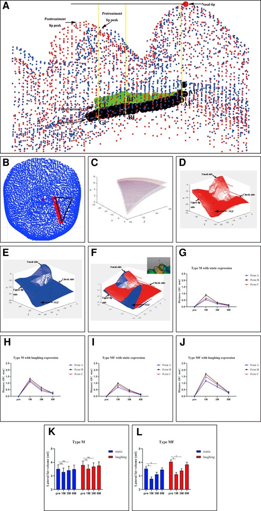 (A) Taking the nasal tip as the reference frame, the change in the distance to the nasal tip of the marked points of type MF NLFs after 1 month was measured in Matlab (MathWorks; Natick, MA). (B) The triangular regions determined by the starting point, the stop point, and a point 2 cm from the starting point horizontally from the pretreatment NLF were selected to measure fat volume changes in the lateral areas of the NLF before and after injection. (C) The lateral fat volume was selected and analyzed by Matlab. (D, E) The pretreatment and posttreatment NLF map were generated in Matlab. (F) Both of them were fitted. (G-J) The change in distance of marked points with time was analyzed by Matlab in both type M and type MF NLFs. (K, L) The lateral fat volume in both type M and MF NLFs was chosen and analyzed by Matlab. M, muscular type; MF, muscle–fat pad mixed type; NLF, nasolabial fold.