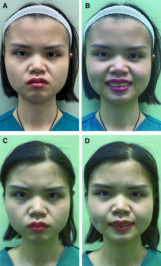 A 24-year-old female with a type MF NLF: pretreatment photographs showing the frontal view (A) in static expression and (B) while laughing. Type MF NLFs combine high tension of muscle contraction and hypertrophy of the fat pad. The fold deepens when standing up and smiling. In the supine position, the fold is reduced due to the smaller effect of gravity on the fat pad compared with when standing up, both for static and laughing expressions. In total, 6 points of the bilateral NLF needed to be injected: the levator labii alaeque nasi, zygomaticus minor, and zygomaticus major muscles (2 U at each injection site). The patient was followed up 1, 3, and 6 months after treatment. She showed significant improvements after 1 month of BTX A treatment: frontal view photographs (C) in static expression and (D) while laughing. BTX-A, botulinum toxin-A; MF, muscle–fat pad mixed type; NLF, nasolabial fold.