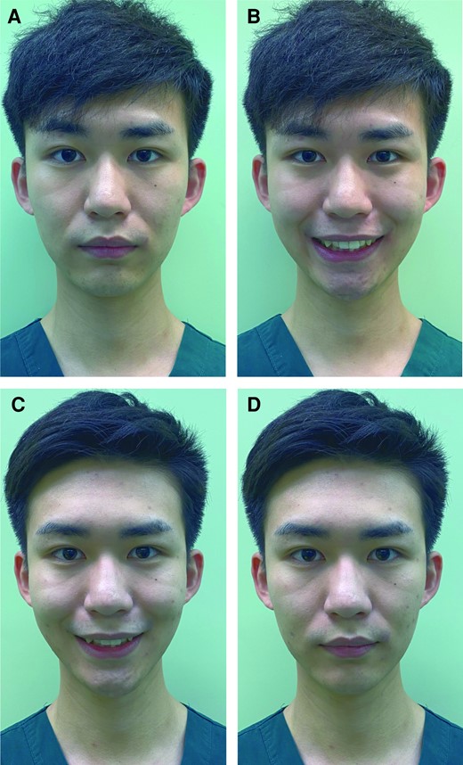 A 29-year-old male with a type M NLF: pretreatment photographs showing the frontal view (A) in static expression and (B) while laughing. For type M NLFs, there is muscular contraction resulting in high tension. The fold deepens when standing up and laughing. In the supine position, the fold shows no apparent change without a thick fat pad compared with when standing up both in static expression and while laughing. In total, 6 points of the bilateral NLF needed to be injected: the levator labii alaeque nasi, zygomaticus minor, and zygomaticus major muscles (2 U at each injection site). The patient was followed up 1, 3, and 6 months after treatment. He showed improvements (C) in laughing expression and no obvious change (D) in static expression in the first month. BTX-A, botulinum toxin-A; M, muscular type; NLF, nasiolabial fold.