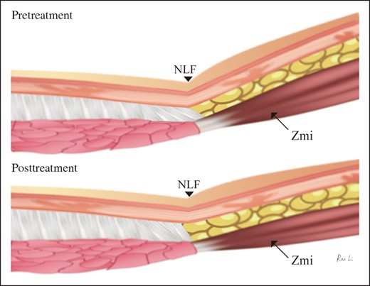 Anatomic diagrams showing the formation and change of the NLF. NLF, nasiolabial fold; Zmi, zygomaticus minor.