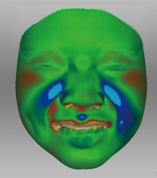 Pretreatment and 1-month posttreatment 3D scans of periocular changes while laughing of a muscle–fat pad mixed-type nasiolabial fold. The red regions indicated that the increased contractile force of orbicularis oculi at 1-month posttreatment.