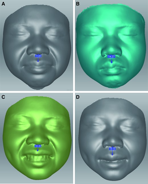 The length change of the philtrum (A, C) before and (B, D) after 1 month of botulinum toxin-A treatment of a muscle–fat pad mixed-type nasiolabial fold.