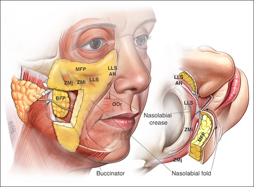The MFP, shown from (left) a right oblique view and (right) a superior view, is a localized triangular-shaped area of increased thickness of the subcutaneous panniculus adiposus in the midcheek. Its medial extent is marked by the nasofacial groove, nasolabial crease, and labiomandibular crease; its lateral extent largely relates to the anterior border of the masseter, although this border is less distinct. The MFP overlies the upper lip levator muscles above the oral commissure, the buccinator muscle and modiolus at the level of the oral commissure, and the risorius, platysma, and depressor anguli oris muscles below the oral commissure. The jowl is formed by the lowest part of the MFP. The nasolabial fold and labiomandibular fold are the parts of the MFP that border and partially overhang the perioral adhesion zone. There is a difference between the nasolabial fold (hanging fullness), and the nasolabial crease (sharp depression). In youth the MFP extends well over the orbital rim into the lower lid up infratarsal crease. However, in the middle-aged and elderly, the MFP over the orbicularis oculi muscle deflates, with its upper edge becoming the tear-trough and palpebromalar groove. LLSAN, levator labii superioris alaeque nasi; BFP, buccal fat pad; OOr, orbicularis oris muscle; ZMi, zygomaticus minor muscle; ZMa, zygomaticus major muscle. Created by and published with permission from Dr Levent Efe, CMI.