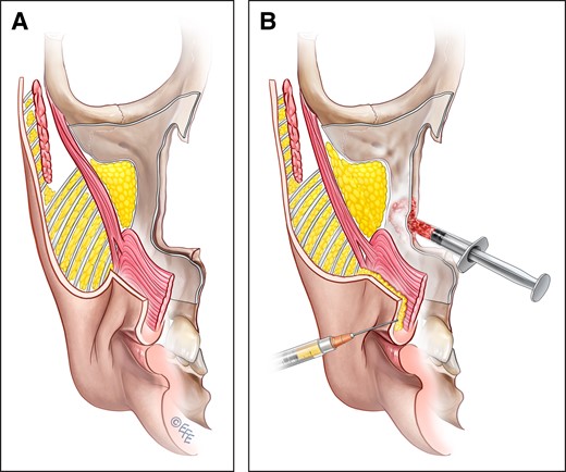 (A) Volume deflation, due to remodeling of the anterior face of the maxilla and fat deflation, adds to the depth of the nasolabial crease, accentuating the nasolabial fold. (B) Volume augmentation can be used to improve the nasolabial crease, using either hydroxyapatite to restore the bone projection of the underlying maxilla or increasing the soft-tissue volume of the nasolabial crease and the upper lip area by lipofilling or commercial fillers. Created by and published with permission from Dr Levent Efe, CMI.