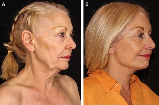 A 62-year-old female patient (A) before and (B) 6 months after a traditional deep-plane facelift and lip lift without anterior melo fat pad sutures or addition of volume (no lipofilling or hydroxyapatite). Note the improved lid cheek junction with improved malar highlight, as well as the jawline, jowl, and neck improvement, whereas the nasolabial fold remains essentially uncorrected. Courtesy of Dr Anh Nguyen of Perth, Australia.