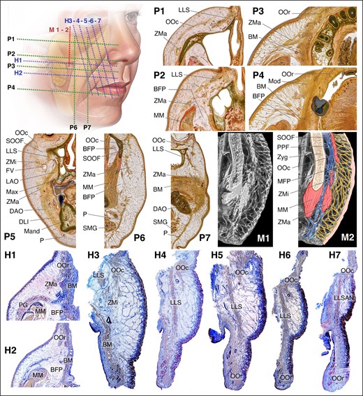 Microscopic studies of the face. Sheet plastination cross sections of the midcheek in the axial plane (P1-P4), the coronal plane (P5), and the sagittal plane (P6-P7). Microcomputed tomography in a vertical plane perpendicular to the skin (M1-M2). Histology in the axial plane (H1-H2) and in the plane parallel to the ZMa and perpendicular to the skin (H3-H7). The MFP marks the localized increased volume of the subcutaneous fat. The retinacula cutis provide structural architecture to this subcutaneous entity in a consistent arrangement, essentially perpendicular to the skin. LLS, levator labii superioris; OOc, orbicularis oculi muscle; ZMa, zygomaticus major muscle; OOr, orbicularis oris muscle; BM, buccinator muscle; BFP, buccal fat pad; MM, masseter muscle; Mod, modiolus; SOOF, sub-orbicularis oculi fat; ZMi, zygomaticus minor; FV, facial vein; LAO, levator anguli oris; Max, maxilla; DAO, depressor anguli oris; DLI, depressor labii inferioris; M and, mandible; P, platysma; SMG, submandibular gland; PPF, pre-periosteal fat; Zyg, zygoma; MFP, melo fat pad; PG, parotid gland; LLSAN, levator labii superioris alaeque nasi.