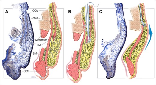 Histology, with accompanying illustration, demonstrating the mechanical effect of lifting the MFP and NLF through a deep-plane approach. (A) Preoperative situation of an aged midcheek showing the ptotic MFP and NLF. (B) Illustration of the procedure performed through the prezygomatic space, deep to the OOc but over the ZMa and ZMi with the suture bite deep within the MFP. (C) Immediate result after the MFP lift, demonstrating not only an adequate effacing of the NLF, but also a change in the orientation of the retinacula cutis from a hanging-down pattern into an upward-pulled pattern. This can only be explained by traction by the suture being transmitted to the skin, not through the MFP itself. BM, buccinator muscle; MFP, melo fat pad; NLF, nasolabial fold; OOc, orbicularis oculi muscle; OOr, orbicularis oris muscle; ZMa, zygomaticus major muscle; ZMi, zygomaticus minor muscle. Created by and published with permission from Dr Levent Efe, CMI.