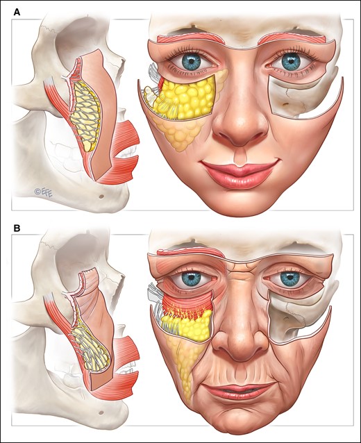 The typical aging pattern of the midcheek. In general, deflation of the MFP with elongation of the retinacula cutis adds to the redundancy of soft tissues causing the nasolabial fold. Near-total deflation of the MFP over the orbicularis oculi muscle causes the infratarsal crease to disappear, marking the upper extent of the MFP in youth, and the tear-trough and palpebromalar groove to form, marking the upper extent of the MFP with aging. The MFP becomes teardrop-shaped, with fat accumulation above the nasolabial crease. Resorption of the anterior maxilla and deep fat deflation contributes to the flattening of the midcheek. There is no evidence for zygomaticus major muscle elongation/stretch, with the zygomaticus major muscle maintaining the position of the nasolabial crease. MFP, melo fat pad. Created by and published with permission from Dr Levent Efe, CMI.