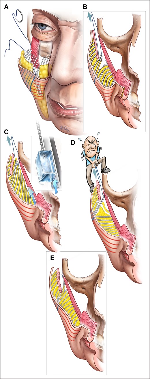 Mechanism of action of a deep-plane facelift with composite flap of the cheek, with the skin and MFP, in this case through a prezygomatic space dissection extending over the origin of the zygomaticus major and minor muscles. The undermined part is indicated by blue lines on the skin, while the part not undermined is indicated by red lines. (A, B) Sutures are placed in the deep aspect of the MFP at the most anterior-inferior extent of the dissection, to suspend the fat pad to the periosteum of the zygoma. (C) It is often assumed that the MFP slides en bloc over the underlying mimetic muscles with aging and can hence be lifted using the same sliding principle.1 (D) However, the mechanical testing and histology demonstrated that the nonreleased part of the MFP (ie, the part distal to the suture) is held up by the skin tension rather than tension conducted through the MFP. This distal skin–mediated lift results in a change of the architectural organization of the nonreleased part of the MFP from a gravity-opposing “hanging-down” organization to a “pulled-up” organization which does not oppose gravitational pull (Figure 4C). As a result, the entire flap distal to the placed suture, including the MFP and upper lip, are effectively suspended by the skin tension. (E) Following the surgery, the released and suspended superolateral cheek volume remains high and lateral, contributing to the periorbital fullness for the long term, whereas over the nonreleased part of the cheek the skin relaxation process will continue without the gravity-opposing retinacula cutis until relapse occurs, effectively undoing the initial result and causing recurrence of the NLF. The end result is a retained high and lateral position of the dissected MFP, which was brought onto the zygoma, and a flattening of the midcheek due to stretching of the skin and MFP with the volume being distributed over a larger area than preoperatively. MFP, melo fat pad. Created by and published with permission from Dr Levent Efe, CMI.