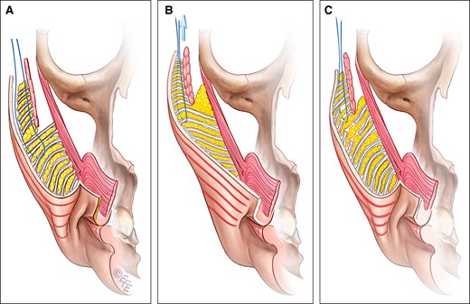 No-release facelifts, in which the anterior midcheek is being lifted without being first undermined (eg, SMAS-plication, SMASectomy, S-lift, MACS lift, PRS-lift, thread lift), do not result in a stable healed situation. (A) In this illustration, the third MACS-lift suture placed through a superficial subcutaneous dissection is demonstrated. (B) The normal gravity-opposing hanging-down pattern of the retinacula cutis is changed to a pulled-up pattern in which the entire weight of the flap is supported by the sutures and the skin tension. (C) Skin relaxation and weakening of the fixation (a process sometimes referred to as “cheesewiring’) contributes to recurrence of the nasolabial fold. MACS, minimal access cranial suspension technique; SMAS, superficial musculoaponeurotic system. Created by and published with permission from Dr Levent Efe, CMI.