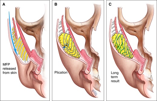 MFP plication, as introduced by Little, involves (A) releasing the MFP from the skin then (B) a no-tension plication to reduce the surface area and increase the projection of the MFP. In the process, the lowest part of the MFP and jowl is lifted to a higher position without tension being placed on the skin and underlying muscles. (C) Healing, with fat remodeling, is proposed to explain the long-term increased plumpness of the MFP. Note how this technique does not by itself improve periorbital hollowness as does the deep-plane composite lift of the released MFP en bloc onto the zygoma. MFP, melo fat pad. Created by and published with permission from Dr Levent Efe, CMI.