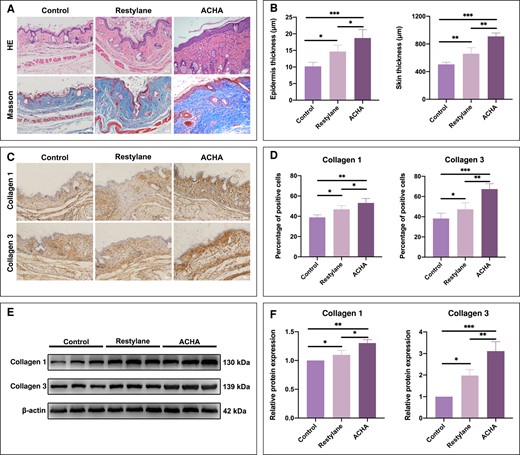 Amino acid–cross-linked hyaluronic acid (ACHA) could enhance epithelial hyperplasia and collagen synthesis. (A, B) HE staining was performed to evaluate the epidermis thickness and skin thickness and Masson staining was performed to evaluate collagen deposition 4 weeks after injecting hyaluronic acid into the dorsal skin of nude mice (scale bar = 200 μm). (C, D) Immunohistochemistry detecting the staining of collagen 1 and collagen 3 proteins in the dorsal skin of nude mice (scale bar = 200 μm). (E, F) Western blot analysis was performed to detect collagen 1 and collagen 3 protein expression in the dorsal skin of nude mice. *P < .05, **P < .01, ***P < .001. HE, hematoxylin and eosin; kDa, kilodalton.