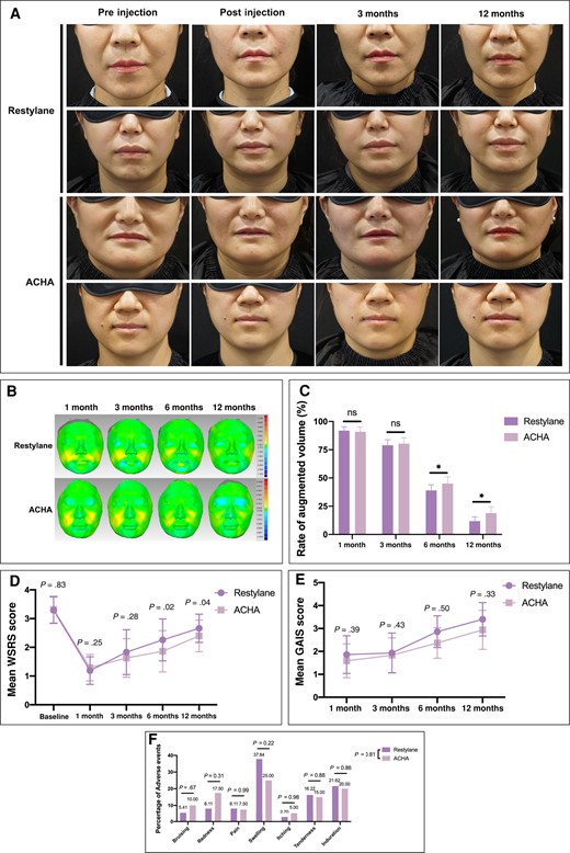 The clinical evaluation of amino acid–cross-linked hyaluronic acid (ACHA) compared to Restylane. (A) Representative photographs of patients’ nasolabial folds obtained before injection, immediately after injection, 3 months postinjection, and 12 months postinjection. (B) Three-dimensional visualizations illustrated the hyaluronic acid filler retention in the ACHA and Restylane groups via Geomagic software. (C) Quantitative statistics of the mean volume changes in the augmented volume at follow-up visits compared to immediately after surgery. (D) Comparison of mean Wrinkle Severity Rating Scale (WSRS) scores between groups. (E) Comparison of Global Aesthetic Improvement Scale (GAIS) scores between groups. (F) Comparison of adverse events rates between groups. *P < .05. ns, not significant.