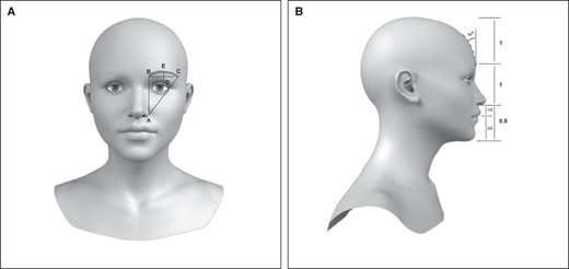 (A) Westmore brow. (A) Ala; (B) Medial brow; (C) Lateral brow; (AC) Oblique line drawn from ala through the lateral canthus to lateral brow; (D) Lateral limbus; (E) Brow apex. (B) Forehead length and angle.