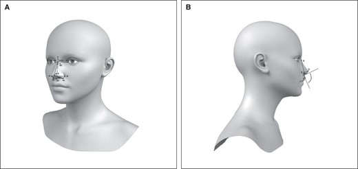 (A) Nasal measurements as per Farkas: nose height (n-sn dotted), nasal bridge length (n-prn), nasal root depth (sagittal) (m(s)), nasal root width (horizontal) (mf-mf), nasal root slope length (m-en), soft nasal tip protrusion (sn-prn), soft nose width (al-al), ala length (ac-prn). (B) Combination of nasolabial angle and Crumley 1 method for defining nasal tip projection. (A) Vertex of nasofrontal angle; (B) perpendicular from line (AE) through (D); (D) tip defining point; (E) vermilion-cutaneous junction of upper lip.