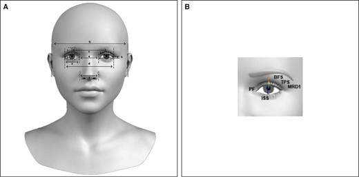 (A) Anthropometric measurements, frontal view: (a) horizontal dimension of palpebral fissure (exocanthion-endocanthion); (b) vertical dimension of palpebral fissure (palpebrale superius–palpebrale inferius); (c) interpupillary distance (center of pupil–center of pupil); (d) binocular width (exocanthion-exocanthion); (e) intercanthal width (endocanthion-endocanthion); (f) nasal width (distance between the widest point on each ala); (g) midfacial width (tragus-tragus); (h) slant of palpebral fissure (angle of the line between endocanthion and exocanthion of an eye based on the line connecting the right and left endocanthion); (i) height of upper eyelid (perpendicular distance between palpebrale superius and lower margin of the eyebrow); (j) width of pretarsal crease (palpebrale superius–upper margin of crease). (B) Eyelid measurements: brow fat span (BFS), red line; tarsal platform show (TPS), yellow line; margin to reflex distance 1 (MRD1), green line; palpebral fissure (PF), blue line; inferior scleral show (ISS), pink line.