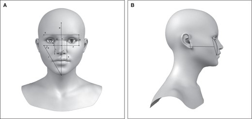 (A) WIZDOM (width of the interzygomatic distance of the midface) parameter: (A) corneal diameter; (B) interpupillary distance; (C) nasal length; (D) medial canthus; (E) brow length; (F) WIZDOM; (G) WIZDOM to medial canthus; (H) hairline to WIZDOM; (I) chin to WIZDOM; (J) chin to WIZDOM diagonal; (K) angle to WIZDOM; (L) medial canthus to nasal ala; (M) eye length; (N) lateral brow to WIZDOM. (B) Beauty arch.