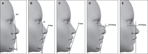 Different methods of soft tissue analysis: (A) Legan and Burstone analysis; (B) Holdaway Analysis (H Line); (C) Ricketts profileanalysis; (D) Merrifield Z-Angle; (E) Epker soft tissue relationships. E-line, Line through Pogonion and nasal tip; FH-Plane, Frankfurt Horizontal; Gn, Glabellar; H, Holdaway soft tissue line; N, Nasion; Pog, Pogonion; Sn, Subnasale.