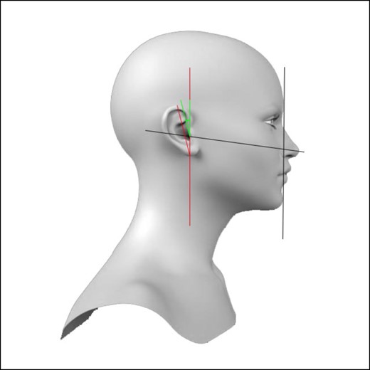 The ear axis. Green line is the angle of the ear axis with respect to the true vertical of the face (red and black lines, axis from nasion to gonion).
