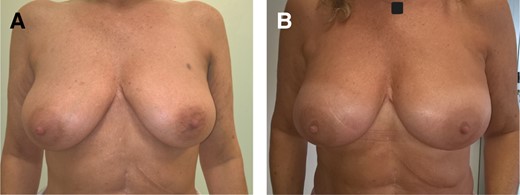 (A) Preoperative view of a 55-year-old female, with BRCA-2 mutation without previous breast-conserving surgery and adjuvant radiotherapy. (B) Postoperative view 16 months after risk-reducing mastectomy (inframammary incision) and immediate direct-to-implant reconstruction with Mentor CPG 323 440-cc implants (Mentor Worldwide, LLC, Irvine, CA). No complications, including capsular contracture, are observed.
