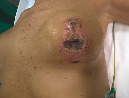 A 47-year-old female patient with previous breast-conserving surgery and adjuvant radiotherapy in her left breast who 18 days after risk-reducing mastectomy and direct-to-implant reconstruction presented full cutaneous necrosis in the nipple-areola complex and vertical incision. The necrotic area was debrided, and the implant was replaced by a Becker 35 expander (Mentor Worldwide, LLC Irvine, CA).