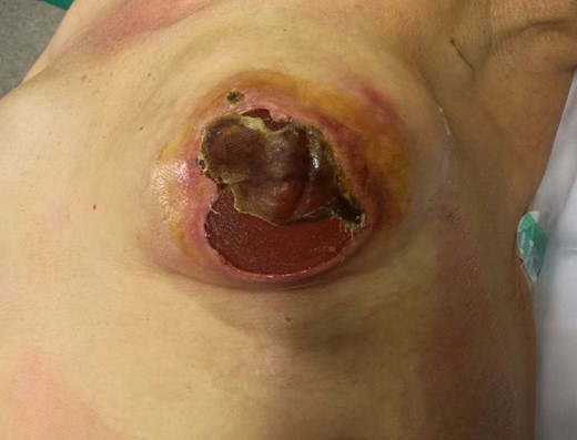 A 51-year-old female patient presenting massive necrosis in the lower nipple-areola complex and the lower outer quadrant of the breast. Although this patient had not not undergone breast-conserving surgery and adjuvant radiotherapy in this breast, she was a heavy smoker. Debridement and temporary removal of the implant was performed.