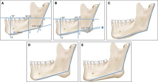 (A) Design of the osteotomy line. (B) Special situation 1 in the design of the osteotomy line: If a gap exists between line Bc and the mandibular lower border, line Bc is shifted upward in parallel while maintaining its angle with the mandibular posterior border until it intersects at point E. (C) Type I of the mandibular angle according to the osteotomy range. (D) Type II of the mandibular angle according to the osteotomy range. (E) Type III of the mandibular angle according to the osteotomy range.