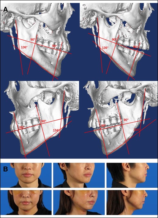 (A) Three-dimensional computed tomography scan of a typical case of type II mandibular angle osteotomy. The upper row is on the right side, and the lower row is on the left side. (B) Preoperative (upper row) and 6-month postoperative (lower row) photographs of a 32-year-old male patient who represents a typical case of type II mandibular angle osteotomy.