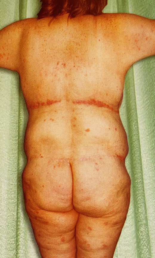 Unrecognized lower body lift deformity in D.J.H. book published in 2013. This 32-year-old MWL female had first-stage LBL with thighplasty and second-stage UBL with spiral flap breast reshaping and brachioplasty. She presented as an exemplary result, but not mentioned were her boxy torso, bulging lateral chest and flanks, flattened hips and buttocks, lateral gluteal depressions, constricting transverse scars, elongated midline gluteal cleft, and saddlebags. Reproduced with permission from Hurwitz DJ. Chapter 8. Sequencing and Timing of Surgery of the Post Bariatric Patient. Cosmetic Surgery After Massive Weight Loss. Thaller SR and Mimmis Cohen M, eds. JP Medical Ltd. 2013, page 70. LBL, lower body lift; MWL, massive weight loss; UBL, upper body lift.