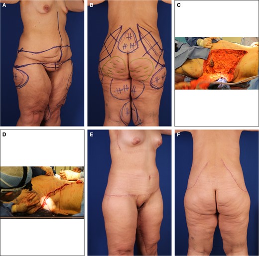 Case 1. (A) Right anterior oblique and (B) posterior preoperative views of 37-year-old, 6′ 1″, 230-pound (BMI 28) female after MWL, with bulky loose-skinned torso and thighs and small, constricted breasts. She is marked for OFLA, VASERlipo, and lipoaugmentation of the buttocks. The transverse lines of her lipoabdominoplasty continue into the oblique flankplasty and are lowered to meet her saddlebags. Obliquely oriented flank excisions are surrounded by pluses for liposuction and minuses for buttock lipoaugmentation. (C) The patient is prone with her head to the right. Her large right flank resection to the lumbodorsal fascia is ready for lateral amputation. (D) With most of the flankplasty closed, the surgeon is approximating the lateral wound by pulling the no. 2 barbed suture while pushing the lateral thigh. (E) Right anterior oblique and (F) posterior views 6 months after OFLA and 4 months after vertical medial thighplasty with pubic monsplasty, extended L-brachioplasty, and submuscular 450-cc breast gel implant augmentation. She has rounded breast enlargement, a flat and tight-skinned abdomen, and absent back rolls with smoothly recessed flanks. Her thighs are smaller, tighter, and conical with no saddlebags. BMI, body mass index; OFLA, oblique flankplasty with lipoabdominoplasty; MWL, massive weight loss.
