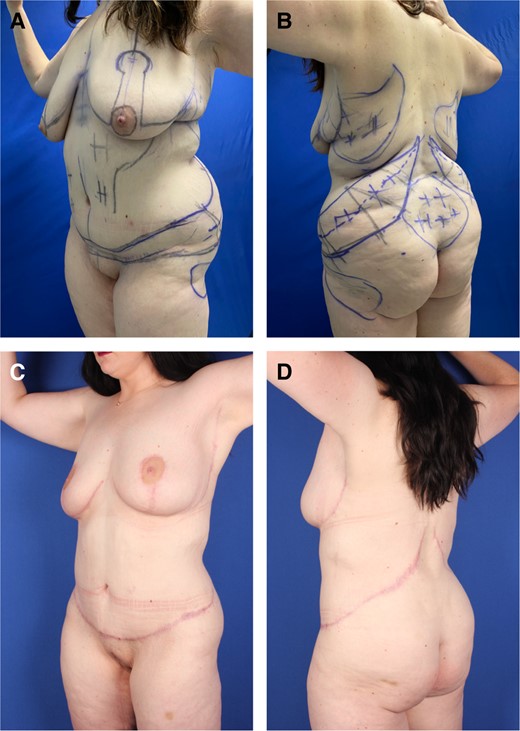 Case 2. (A) Left anterior and (B) posterior oblique preoperative views of an obese, BMI 31.6, 27-year-old female with ptotic, low breasts, multiple large back rolls, and sagging abdomen after 30-pound weight loss. She is marked for OFLA, pluses for VASERlipo, Wise pattern mastopexy, J-torsoplasty, and minuses for lipoaugmentation of lower lateral buttocks. Video shows the marking for OFLA. (C) Left anterior and (D) posterior oblique views 5 months later show fading oblique scars about tight and curvaceous breasts and torso, without rolls of adiposity. BMI, body mass index; OFLA, oblique flankplasty with lipoabdominoplasty.