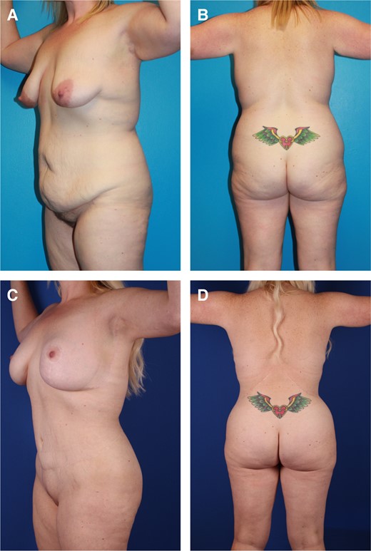 Case 3. (A) Left anterior oblique and (B) posterior views of a 43-year-old normal-weight female after 80-pound weight loss reveal sagging full abdomen, small ptotic breasts, prominent lateral chest rolls, scapula bulges, overfilled flanks merging into oversized hips with depressed lateral gluteal regions and buttocks sagging into saddlebags. (C) Left anterior oblique and (D) posterior views are 6 years after OFLA with lateral gluteal lipoaugmentation followed by J-torsoplasty with spiral flap breast reshaping and L-brachioplasty. Her tight skin and contour improvement persists with imperceptible scars. Her narrowed waist smoothly transitions to a tapering chest and rounded buttocks without elongation of the midline crack. OFLA, oblique flankplasty with lipoabdominoplasty.