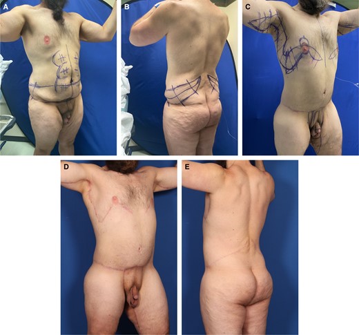 Case 5. (A) Right anterior oblique and (B) left posterior oblique views of an overweight 42-year-old 6′ 2″ male with 150-pound weight loss (400 to 250 pounds, BMI 32.2) show broad gynecomastia with lateral chest lipodystrophy, a distinct inframammary fold, and oversized elongated NACs sagging below the inferior pectoralis major border. Upper arms, protuberant abdomen, mons pubis, and proximal thighs are ptotic. An upper transverse gluteal linear depression is crossed by an elongated midline gluteal crack. He is marked for high-definition liposuction as part of a TULUA, which extends posteriorly into an oblique flankplasty. (C) Right anterior oblique view 6 months after his OFLA shows a tight-skinned well-contoured lower torso. The markings are for a picture frame monsplasty, limited L-thighplasty, and limited L-brachioplasty, extended by a J-torsoplasty into a boomerang excision pattern correction of gynecomastia. (D) Right anterior oblique and (E) left posterior oblique views 5 months after the second stage show a tight-skinned muscular masculine torso and aesthetically reduced upper arms and thighs with short scars. The smoother, rounder, tight buttocks have a shorter midline crack. His gynecomastia is corrected, with a smaller NAC raised to the lower pectoralis muscle and obliteration of the IMF. BMI, body mass index; IMF, inframammary fold; NAC, nipple-areola complex; OFLA, oblique flankplasty with lipoabdominoplasty; TULUA, transverse plication, undermining halted at umbilicus, liposuction, umbilicoplasty with skin graft, and abdominoplasty with low transverse scar localization.