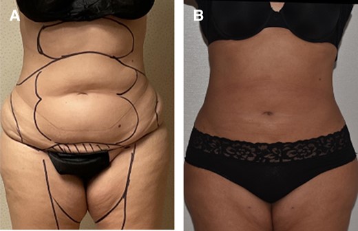 Before (A) and after (B) photographs of 40-year-old patient with moderate fibrosis (palpable firmness of treated area, notably harder than surrounding untreated subcutaneous fat) who was effectively treated with VASER PAL. PAH, paradoxical adipose hyperplasia; PAL, power-assisted liposuction; VASER, vibration amplification of sound energy at resonance.