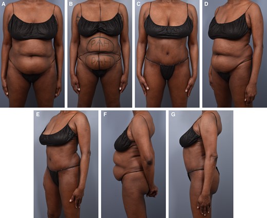 Before (A, B, D, F) and after (C, E, G) photographs of 60-year-old patient with severe and painful fibrosis (palpable and tender firmness with mass effect and abdominal fat distortion) who was treated with PAL-assisted full abdominoplasty. PAH, paradoxical adipose hyperplasia; PAL, power-assisted liposuction.