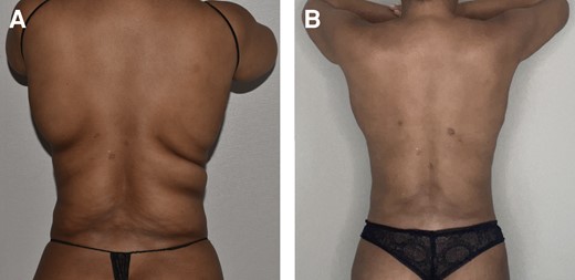 Before (A) and after (B) photographs of 45-year-old patient with moderately fibrotic PAH to flanks who was effectively treated with VASER PAL. PAH, paradoxical adipose hyperplasia; PAL, power-assisted liposuction; VASER, vibration amplification of sound energy at resonance.