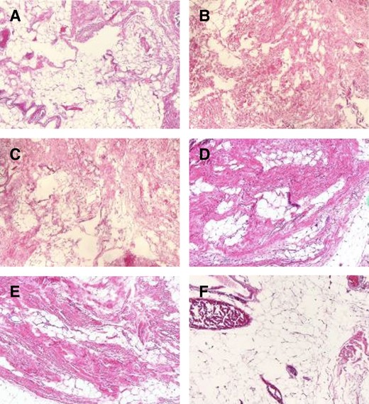 Histology slide. Per pathology report, (A, B, and C) show normal fat. Bands of bland fibrous tissue course through unremarkable adipose tissue. (D, E, and F) show fibrotic (presumed PAH) area. The bands of fibrous tissue are haphazardly arranged, entrapping pockets of adipose tissue. The fibrous tissue is composed of spindle cells with no evidence of increased mitotic rate or cytologic atypia and, therefore, appears to be benign. PAH, paradoxical adipose hyperplasia.