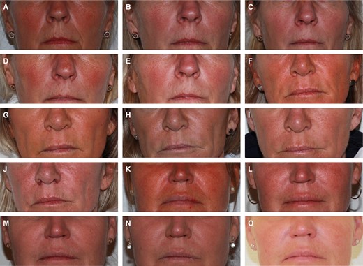 Representative photographs of 3 subjects. (A-E) A 58-year-old woman with Fitzpatrick Type II skin who was treated with DKL23 in the right NLF and with Juvéderm Volift with lidocaine in the left NLF: (A) baseline, (B) 1 month posttreatment, (C) 3 months posttreatment, (D) 6 months posttreatment, (E) 9 months posttreatment. (F-J) A 55-year-old woman with Fitzpatrick Type II skin who was treated with DKL23 in the left NLF and with Juvéderm Volift with lidocaine in the right NLF: (F) baseline, (G) 1 month posttreatment, (H) 3 months posttreatment, (I) 6 months posttreatment, (J) 9 months posttreatment. (K-O) A 51-year-old woman with Fitzpatrick Type III skin who was treated with DKL23 in the right NLF and with Juvéderm Volift with lidocaine in the left NLF: (K) baseline, (L) 1 month posttreatment, (M) 3 months posttreatment, (N) 6 months posttreatment, (O) 9 months posttreatment. NLF, nasolabial fold.