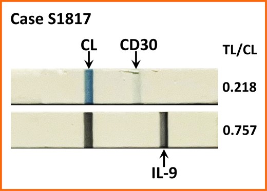 IL-9 lateral flow assay yields a strong TL in case S1817 with only a faint TL for CD30. CL, control line; TL, test line.