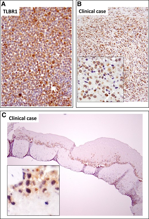 IL-9 and PU.1 immunochemistry. IL-9 was localized to tumor cells in the breast implant–associated anaplastic large cell lymphoma TLBR1 cell line (A) and clinical sample (B). (C) The transcription factor PU.1 necessary for IL-9 production was detected in nuclei of tumor cells. IL-9, interleukin-9.