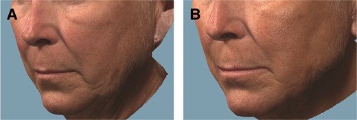 Representative photographs of a 60-year-old white female patient who underwent jawline definition with VYC-25L treatment. The patient received a total injection volume of 4.0 mL at initial treatment and 2.8 mL at touch-up treatment by cannula (with or without a needle): 2.1 mL total for the prejowl area, 1.9 mL for the postjowl area, 1.0 mL for marionette lines, 0.9 mL for the angle of the mandible, and 0.9 mL for the chin. (A) Pretreatment, ALJDS grade 3 (severe); (B) 6 months posttreatment, ALJDS grade 1 (mild). ALJDS, Allergan Loss of Jawline Definition Scale.