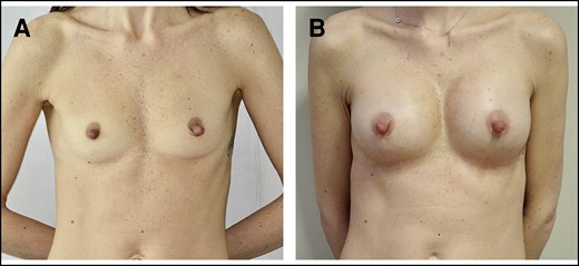 (A) Preoperative underweight 38-year-old patient, BMI = 18.3 kg/m2, pinch test <2 cm. (B) One year post operation, anatomical prosthesis of 322 cc, dual-plane technique, inframammary access site; delta Rasch 24 (preoperative score 28; postoperative score 52). BMI, body mass index.