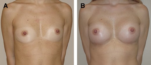 (A) Preoperative 34-year-old patient of normal weight, BMI = 20.2 kg/m2, pinch test < 2 cm. (B) One year post operation, anatomical prosthesis of 295 cc, dual-plane technique, inframammary access; delta Rasch 56 (preoperative score 35; postoperative score 91). BMI, body mass index.