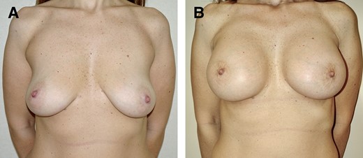 (A) Preoperative 38-year-old patient of normal weight, BMI = 23.8 kg/m2, pinch test ≥2 cm. (B) One year post operation, anatomical prosthesis of 400 cc, dual-plane technique, inframammary access; delta Rasch 83 (preoperative score 17; postoperative score 100). BMI, body mass index.
